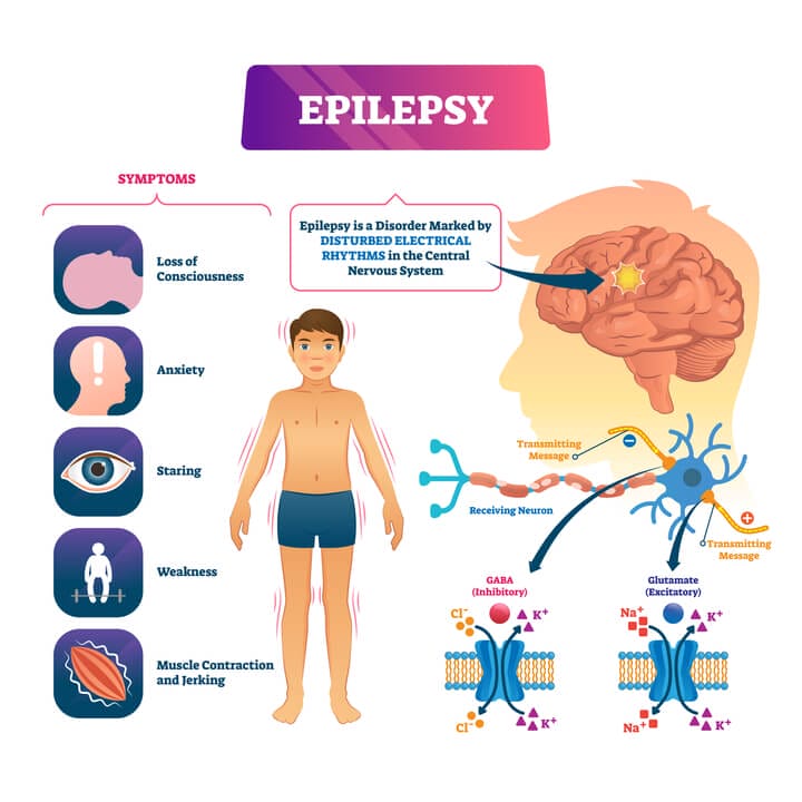 epilepsy body chart